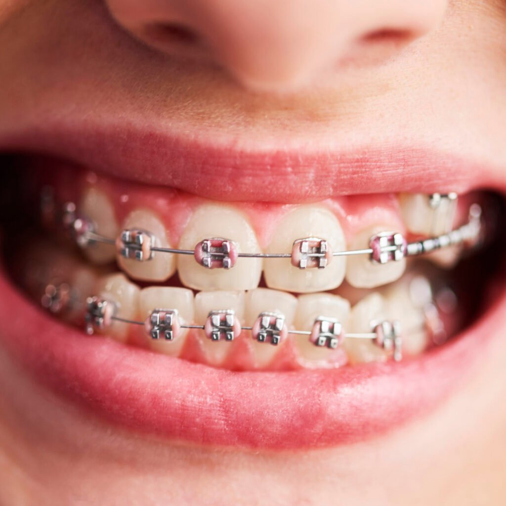 metal braces