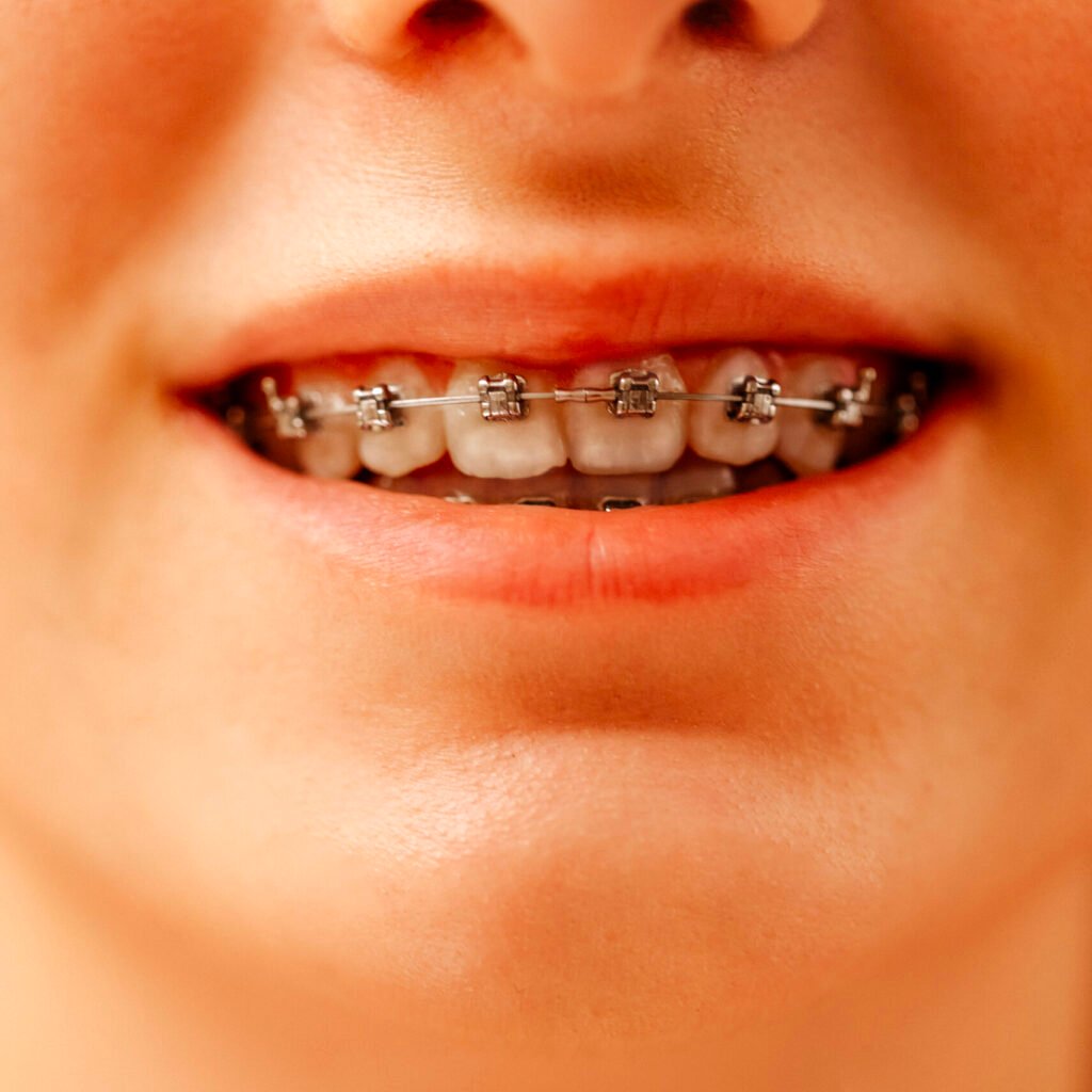 self ligating braces, conventional braces