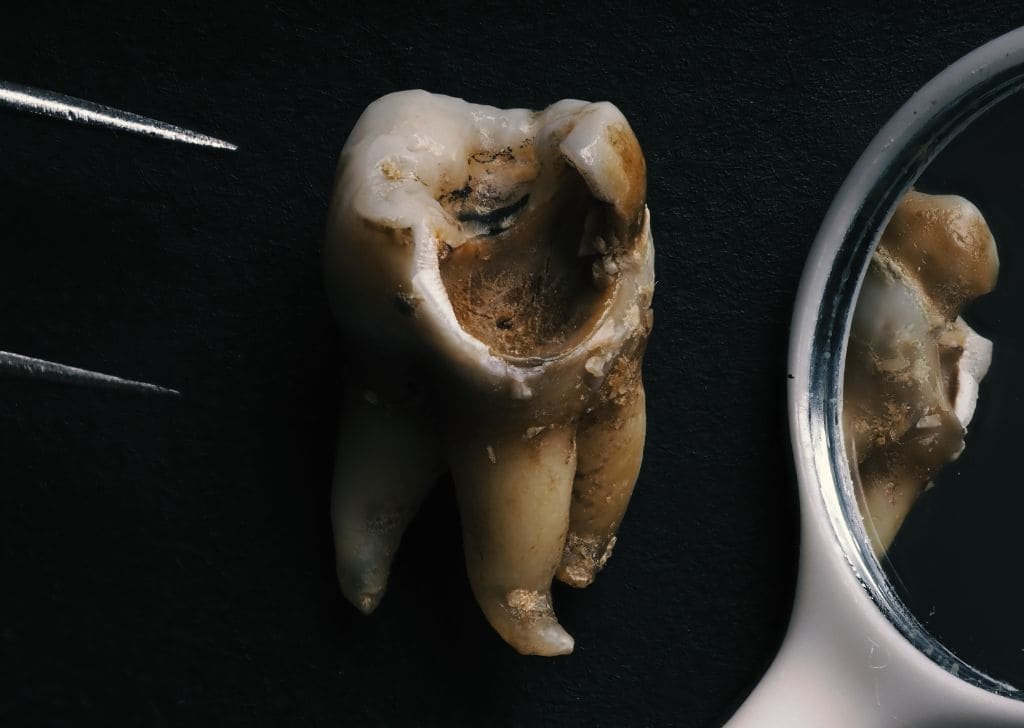 Root Canal Treatment Cost Malaysia | Govt vs Private