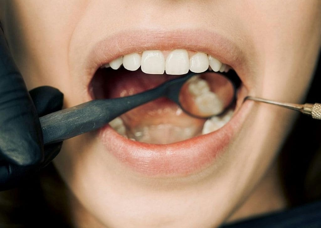 How to Maintain a New Tooth Filling | Expert Guide