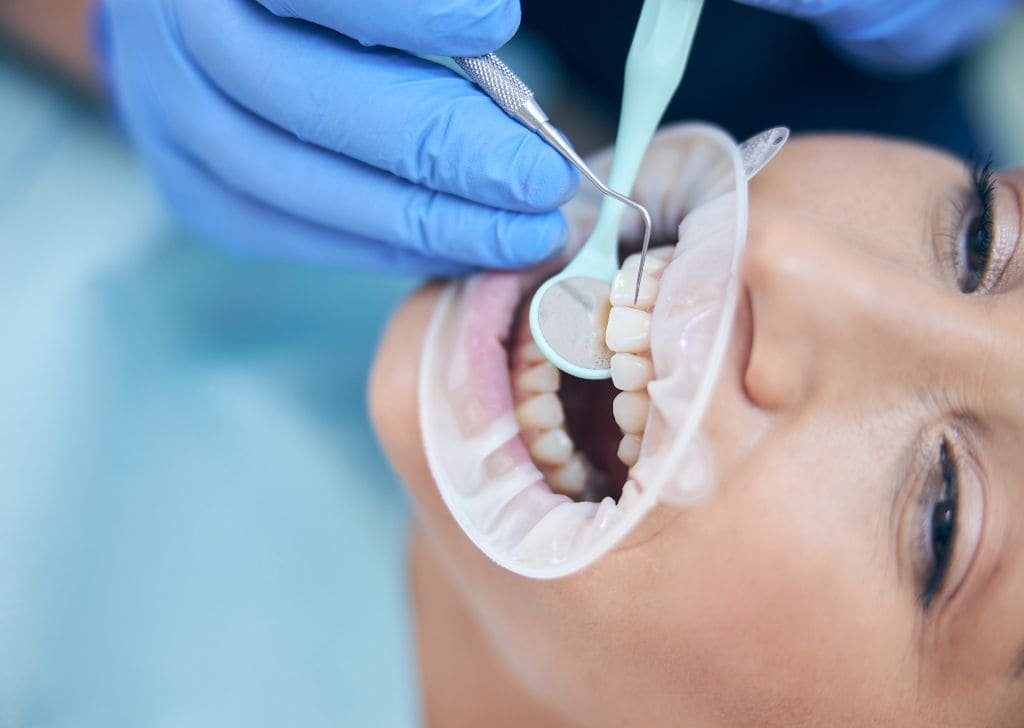 How to Maintain a New Tooth Filling | Expert Guide