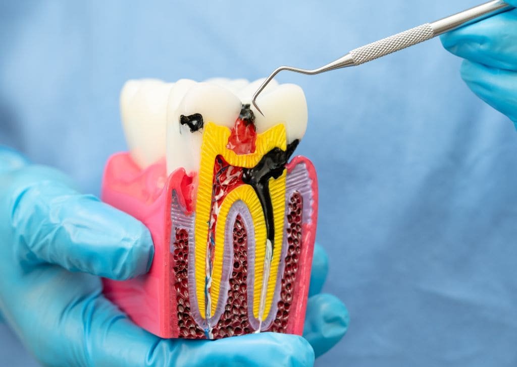 Root Canal Treatment Cost Malaysia | Govt vs Private