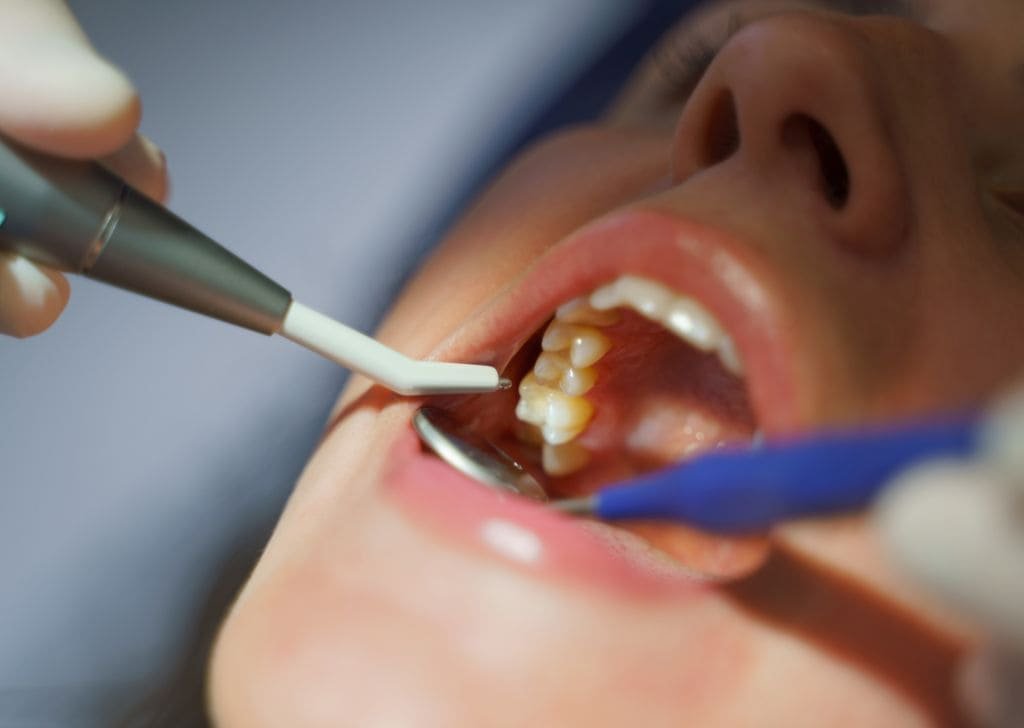 How to Maintain a New Tooth Filling | Expert Guide