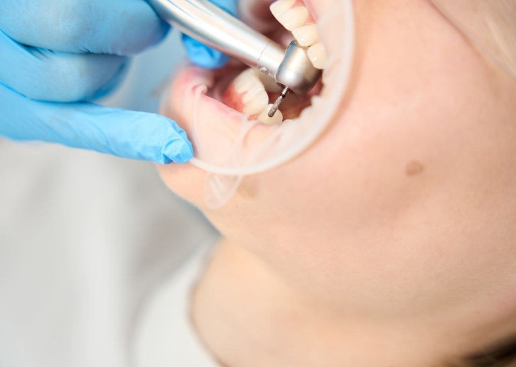 Root Canal Treatment Cost Malaysia | Govt vs Private