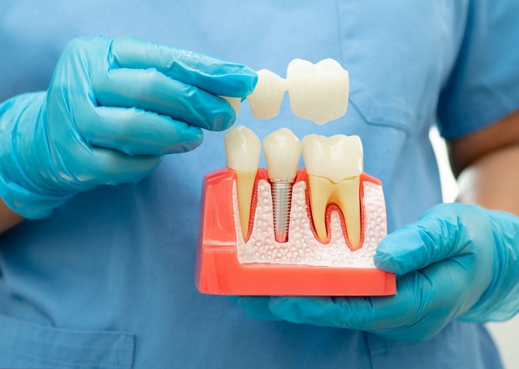 Root Canal Treatment Cost Malaysia | Govt vs Private