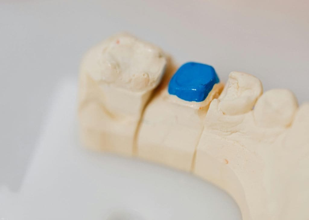 How to Maintain a New Tooth Filling | Expert Guide
