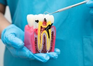 Root Canal Treatment Cost Malaysia | Govt vs Private