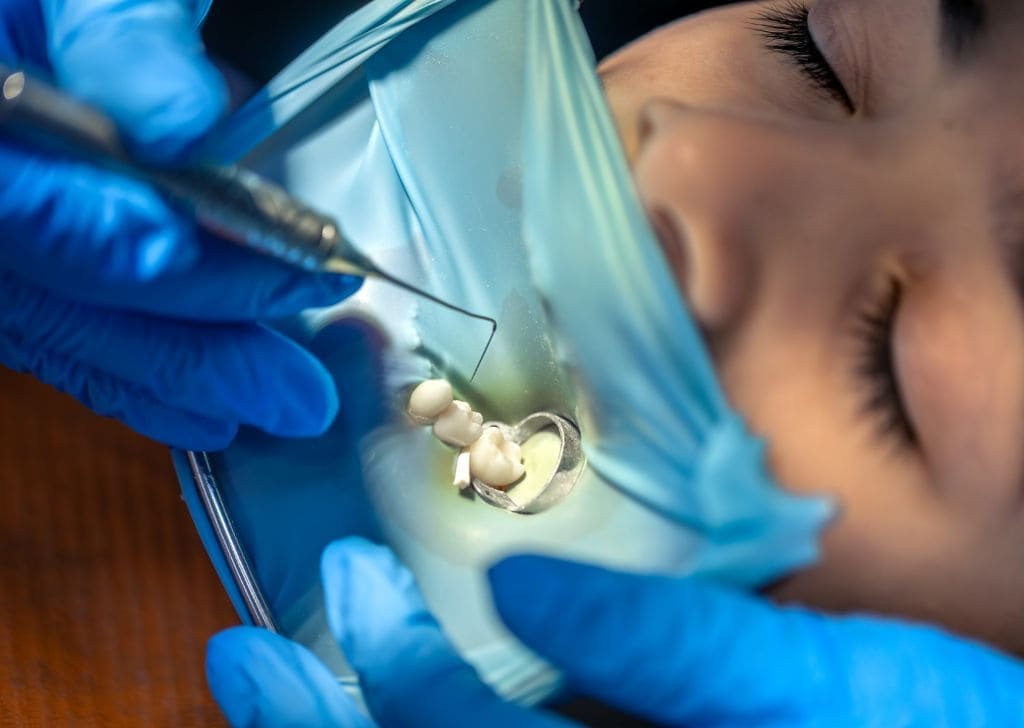How to Maintain a New Tooth Filling | Expert Guide