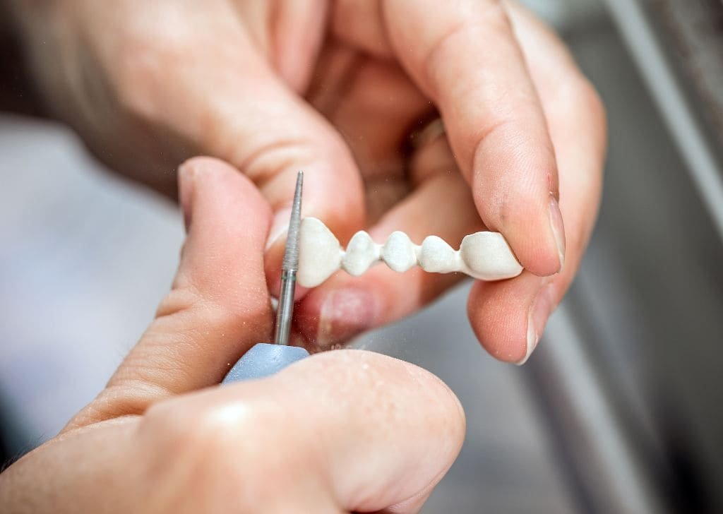 Should I Get a Dental Implant or a Bridge? Let’s Compare