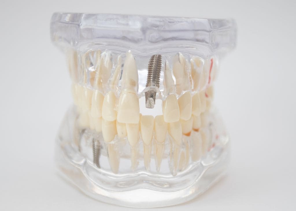 Should I Get a Dental Implant or a Bridge? Let’s Compare