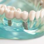 Should I Get a Dental Implant or a Bridge? Let’s Compare