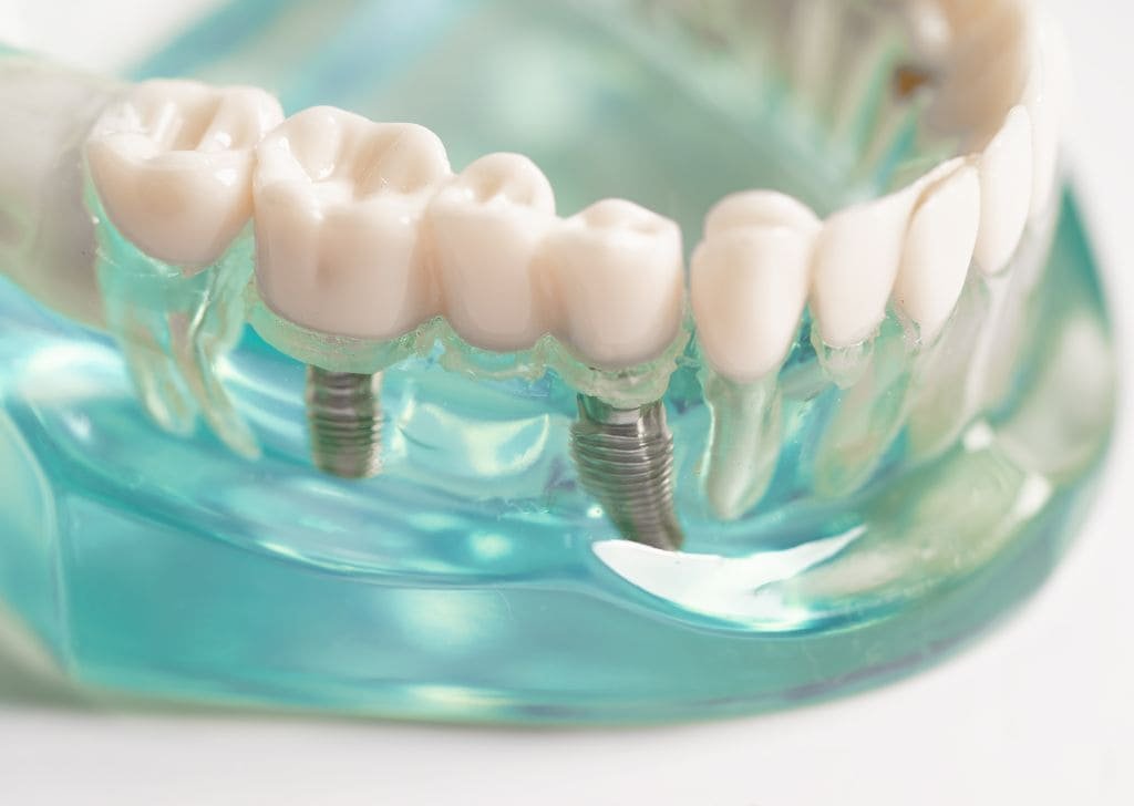 Should I Get a Dental Implant or a Bridge? Let’s Compare
