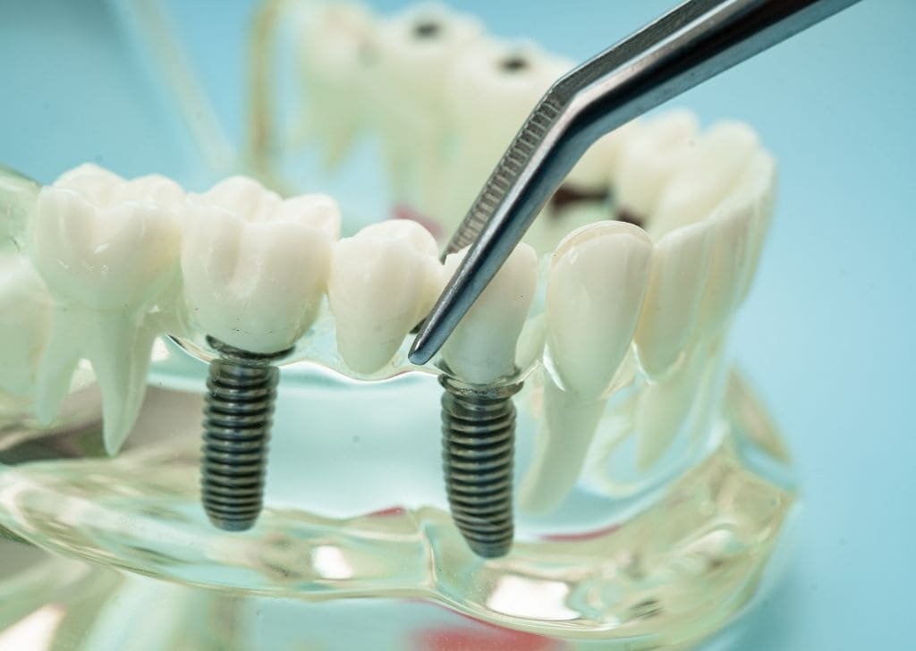 Dental Implant Cost Malaysia - Private vs Government Guide 8 Dental Implant Cost Malaysia - Private vs Government Guide
