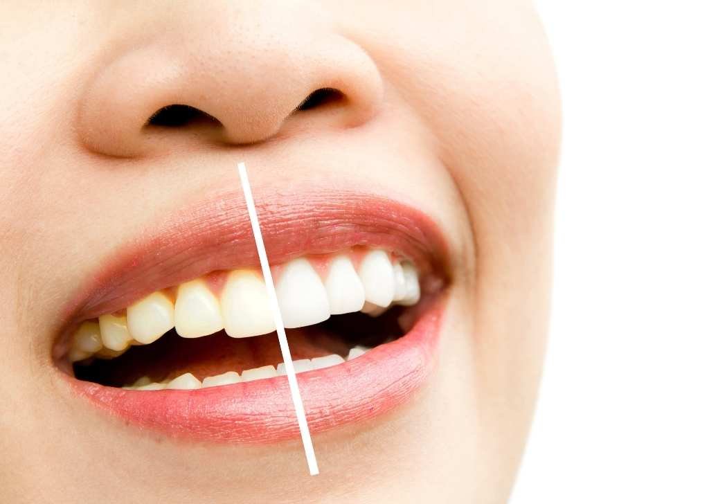Now you know why I have really yellow teeth, here's how to fix it. 