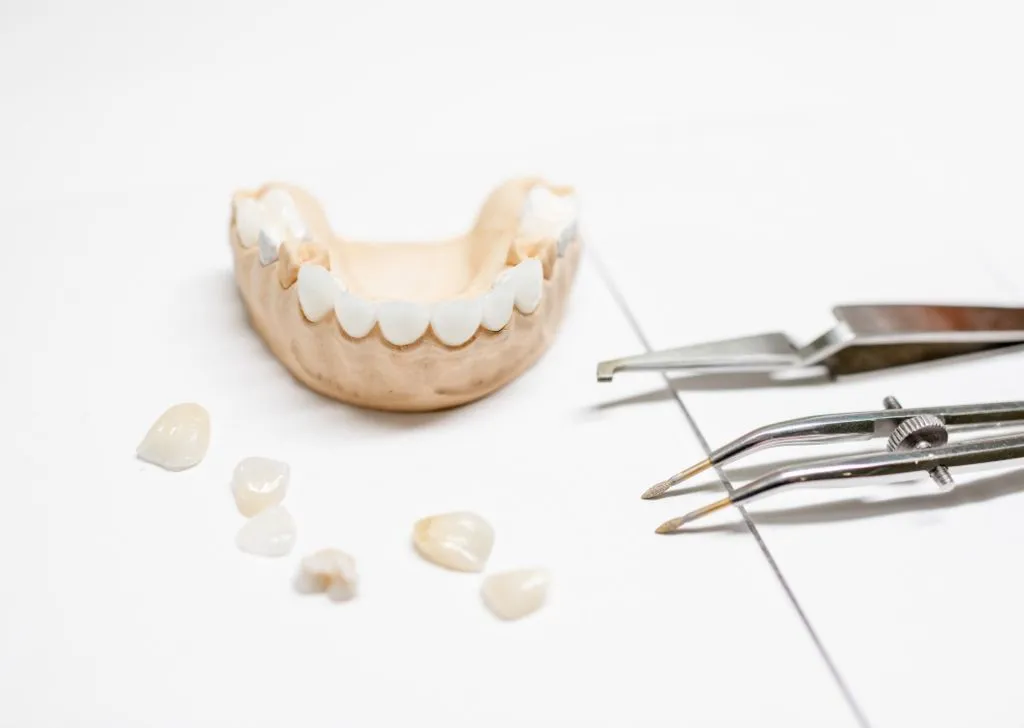 Dental model with veneers plastered on for demonstration. 