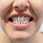 Discover the best ways to fix crooked teeth in Kota Kinabalu — from braces to veneers, aligners, and cosmetic options tailored to your smile.