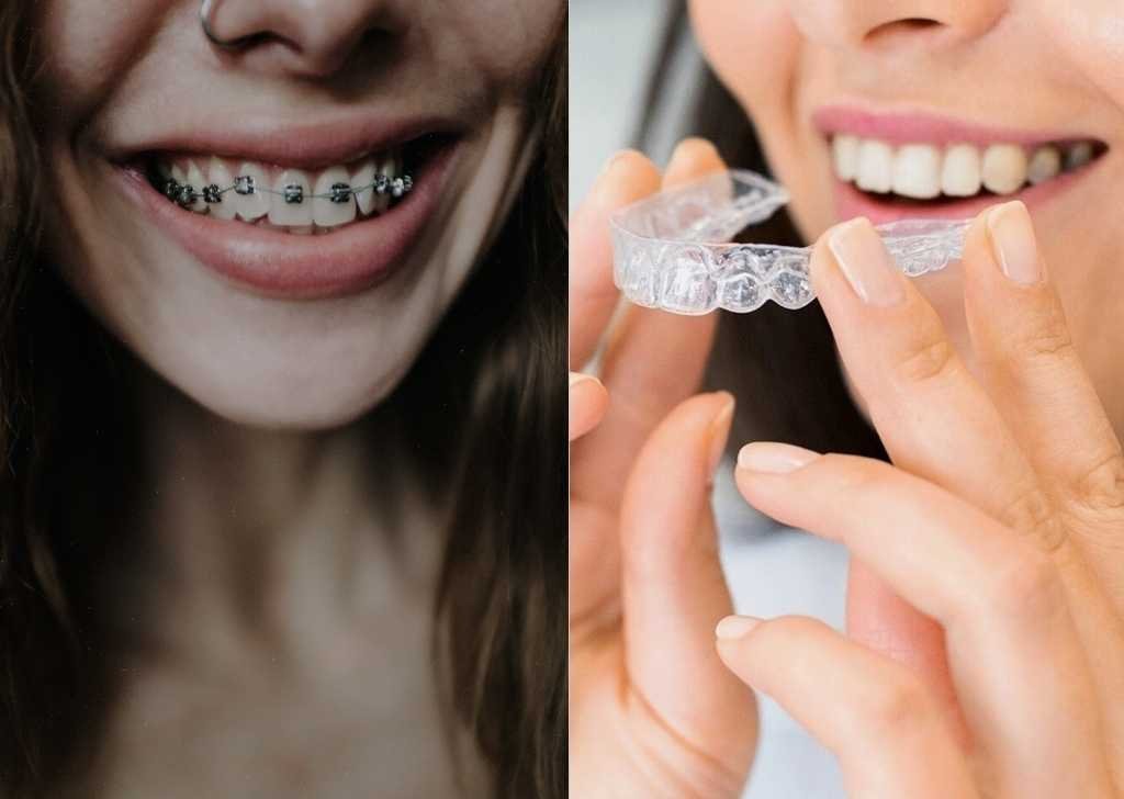 If you want to truly straighten crooked teeth and not just make them look straight, orthodontics is the tried-and-tested route.