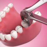 tooth extraction