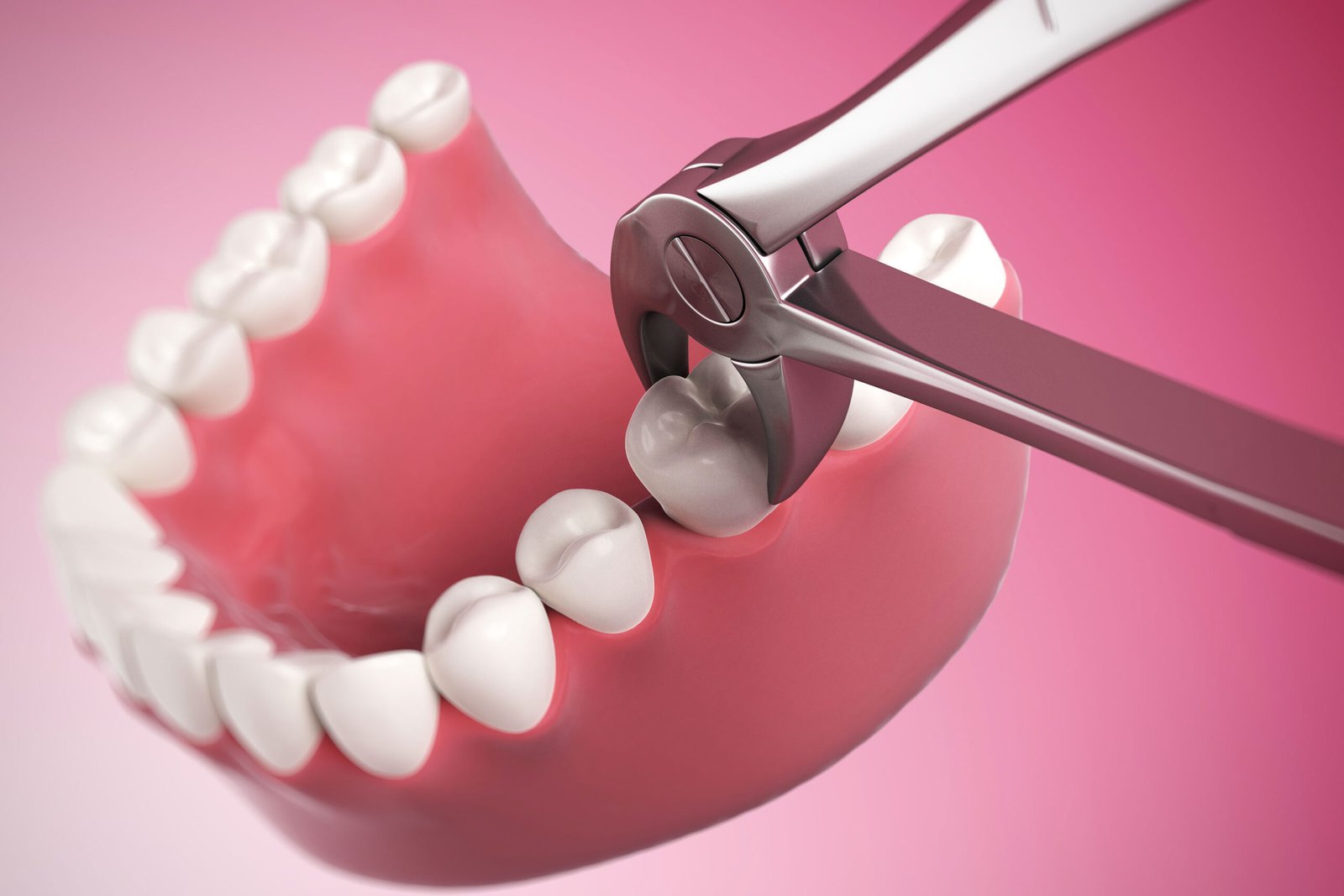 tooth extraction