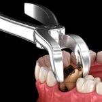 tooth extraction