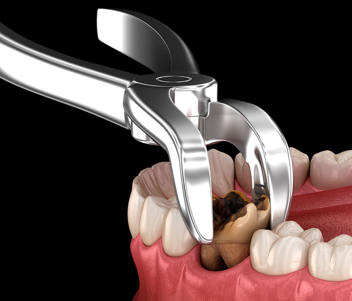 tooth extraction