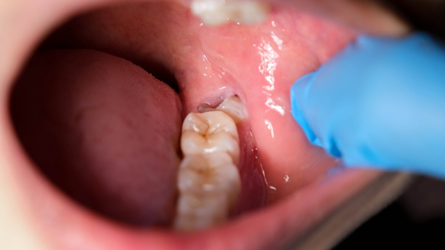 wisdom tooth extraction