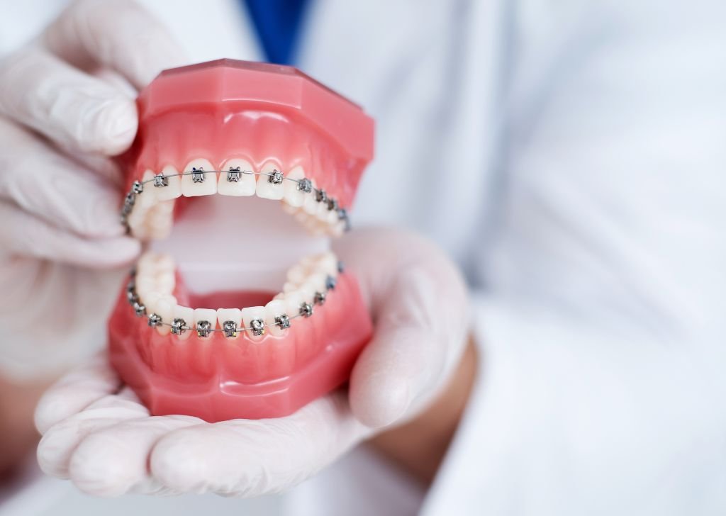 Which Type of Braces Should I Get for My Teeth? 1 2