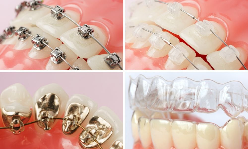 Which Type of Braces Should I Get for My Teeth? 2 Types of Braces