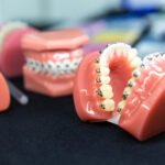 Which Type of Braces Should I Get for My Teeth? 6 cost of having braces