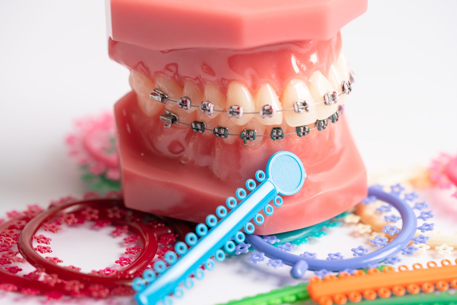 Which Type of Braces Should I Get for My Teeth? 4 Braces