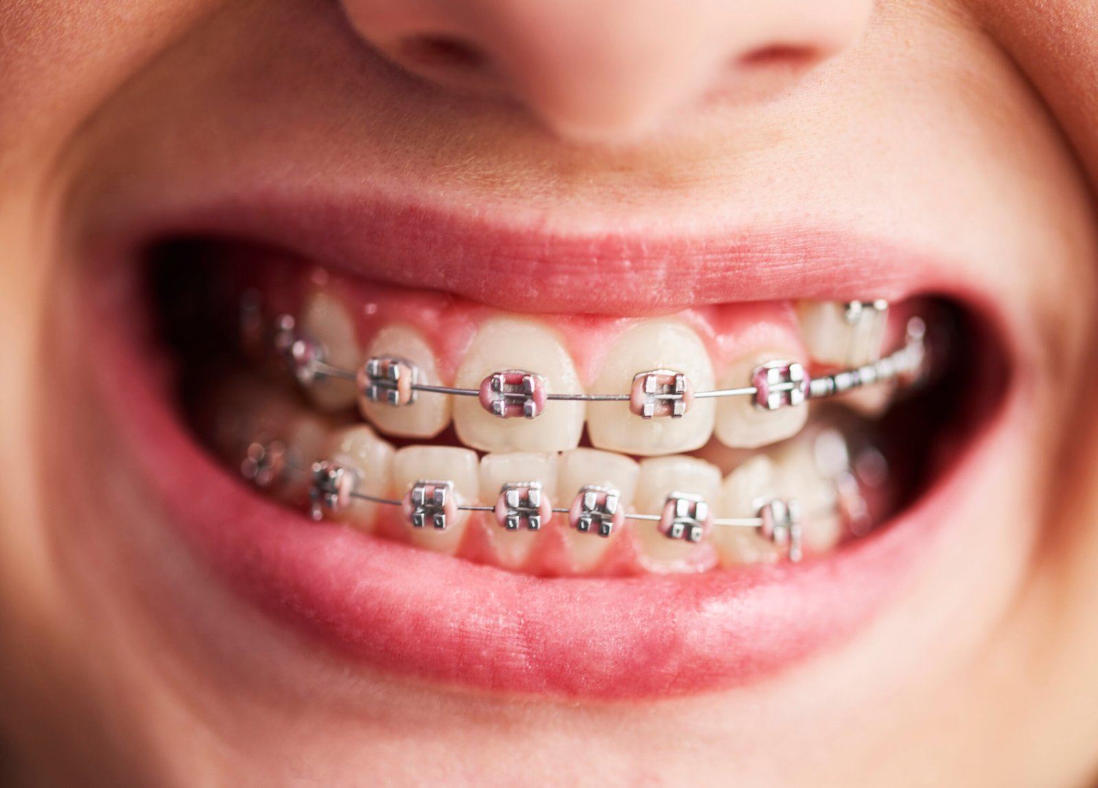 types of braces