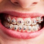 shot of child s teeth with braces 2024 11 26 11 07 14 utc