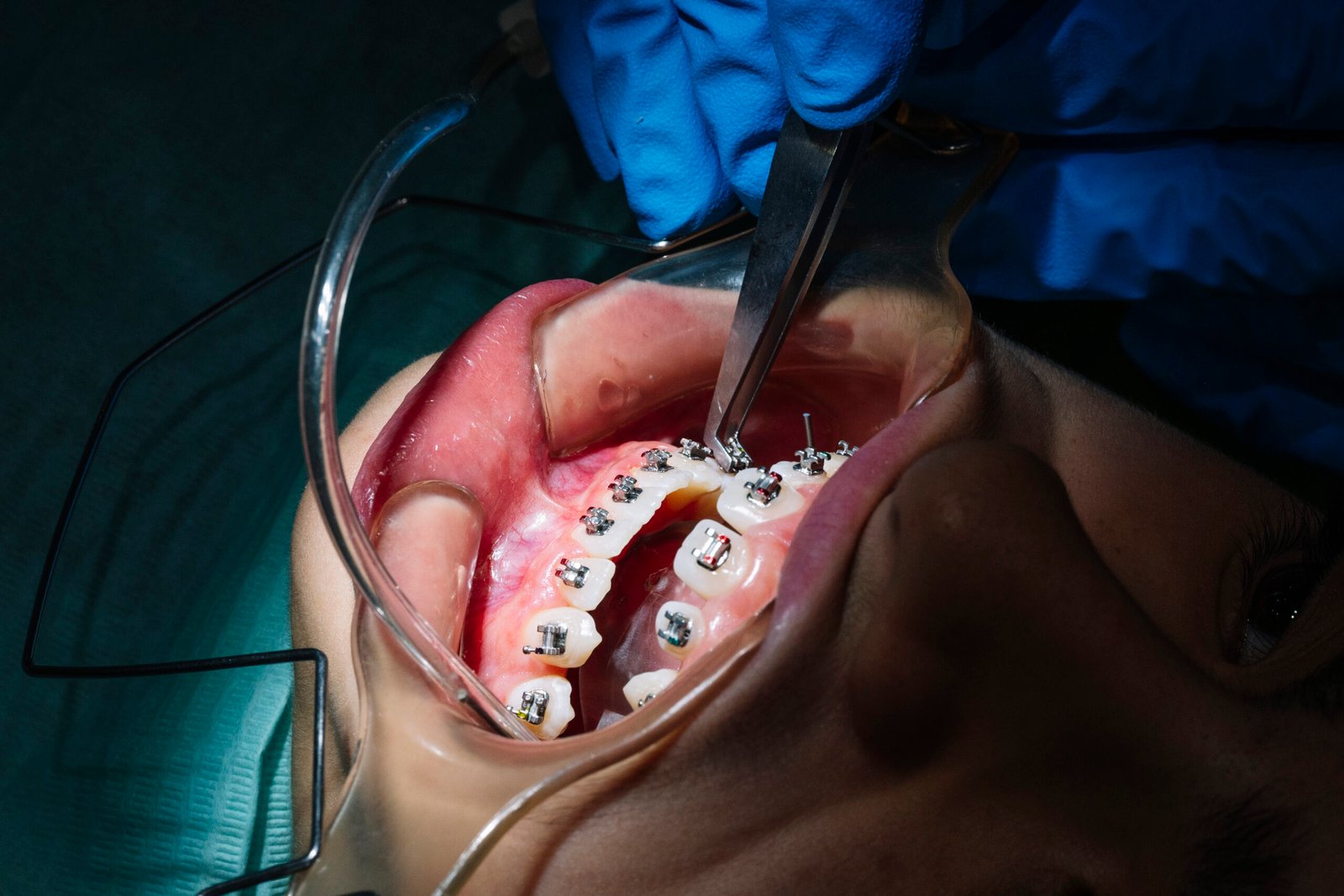 patient doing braces