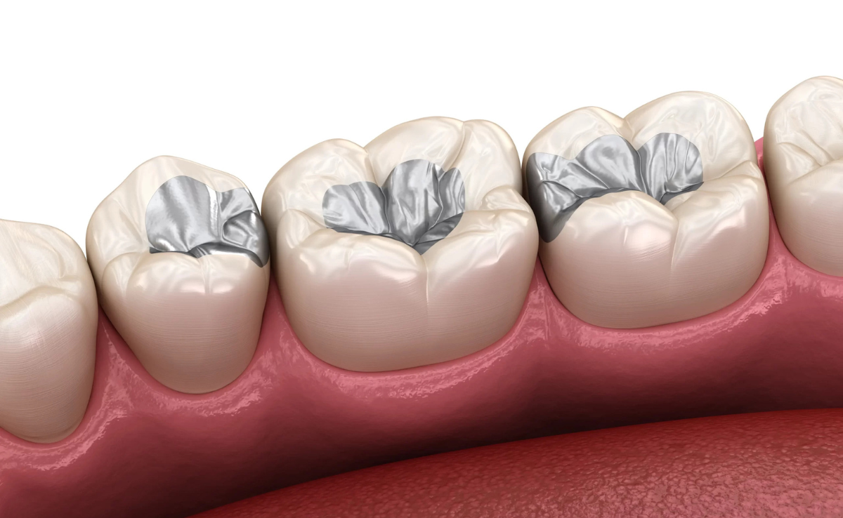Gigi Dah Hitam, Rosak Sampai Ke Akar? Apa Rawatan Paling Berkesan? 4 Tampalan Gigi Komposit
