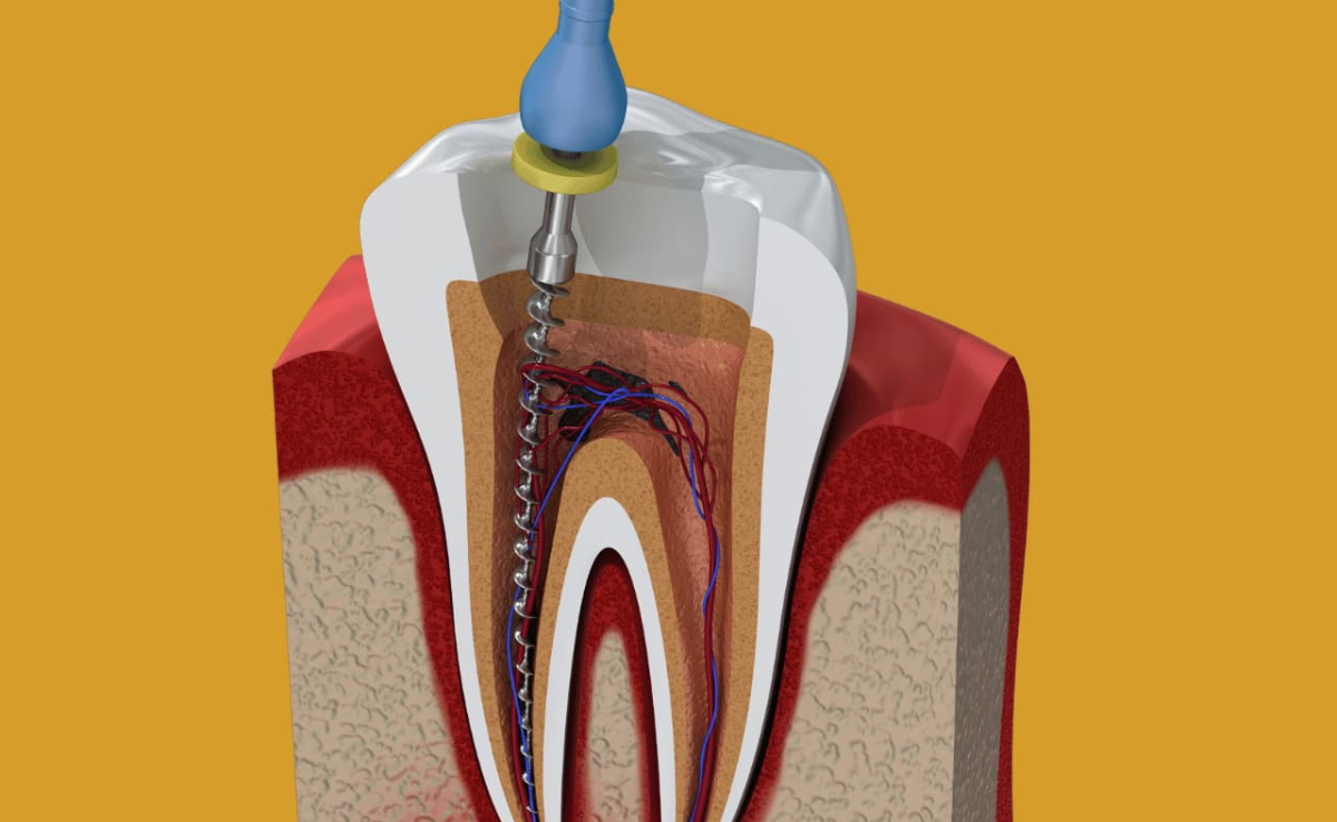 Gigi Dah Hitam, Rosak Sampai Ke Akar? Apa Rawatan Paling Berkesan? 5 Rawatan Saluran Akar