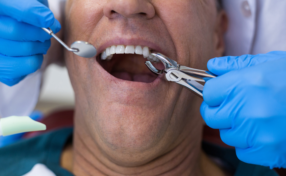 Gigi Dah Hitam, Rosak Sampai Ke Akar? Apa Rawatan Paling Berkesan? 6 Cabut Gigi