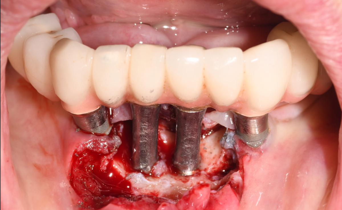 Jangkitan Gusi Implan Gigi