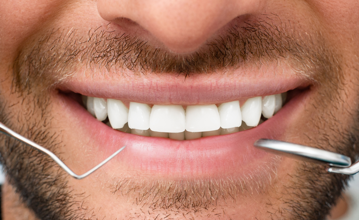 How long  professional teeth whitening last