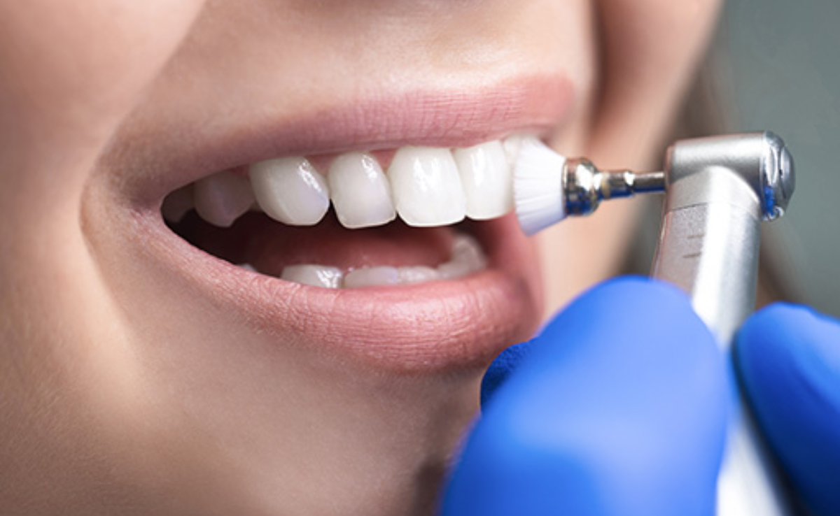Teeth Scaling treatment