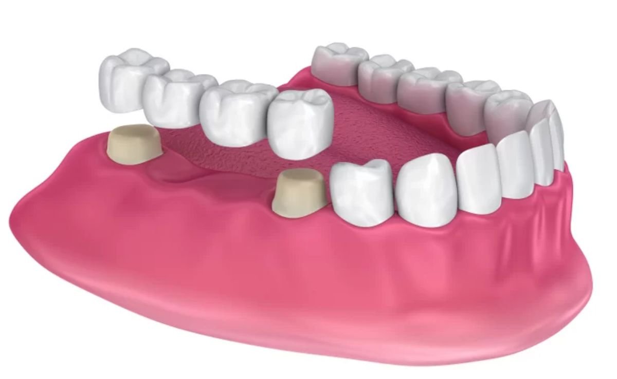 Dental Bridge