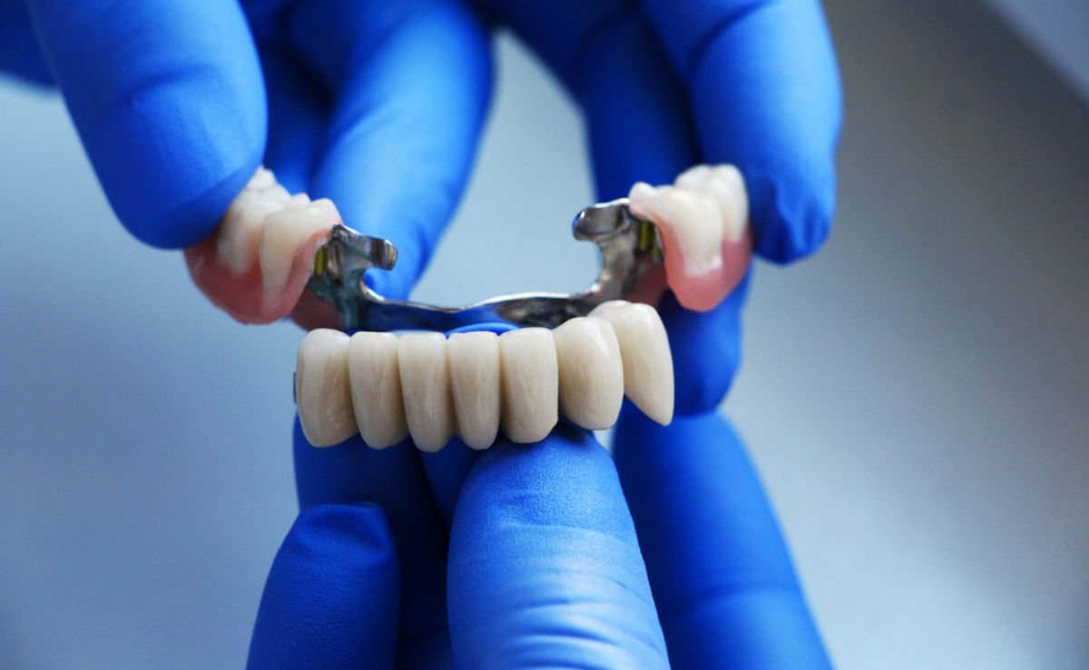 Dental Bridge Installation