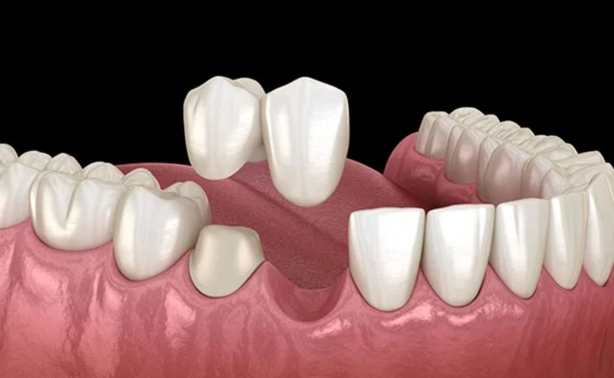 Cantilever Dental Bridge