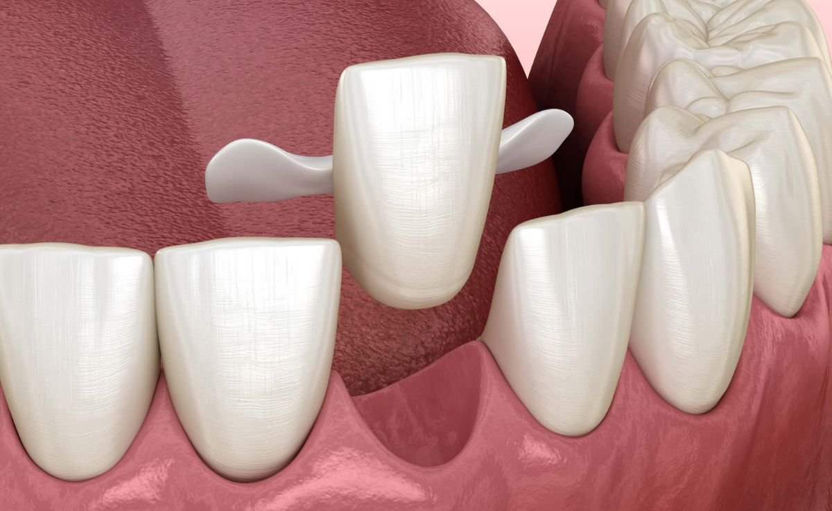 Maryland Dental Bridge