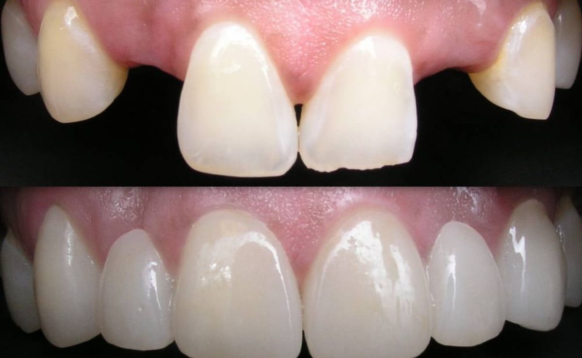 Before and After getting Dental Bridges