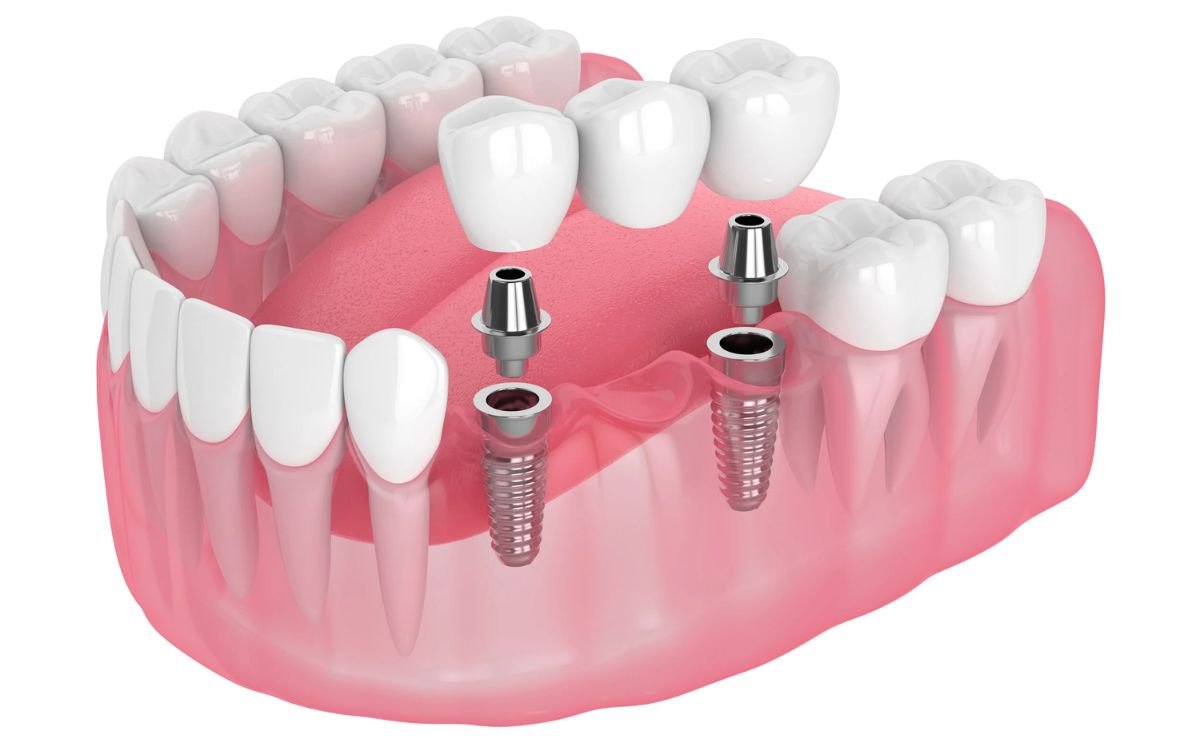 Implant-Supported Dental Bridge