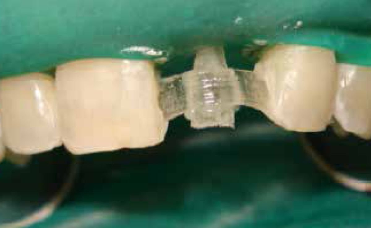 Composite Dental Bridge