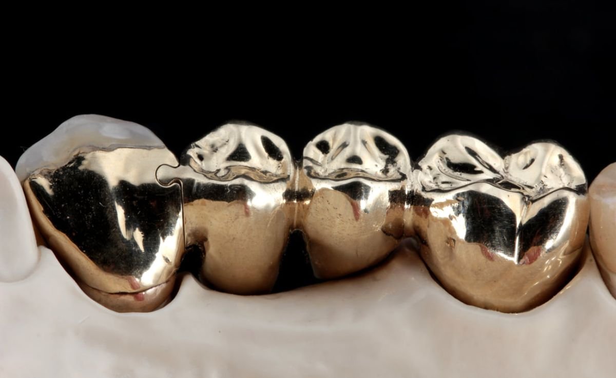 Metal Dental Bridge