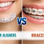 clear aligners vs braces