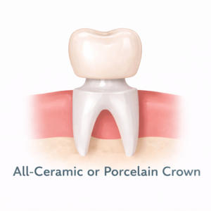 All ceramic crown on prepared tooth