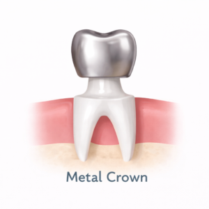 Metal crown on prepared tooth